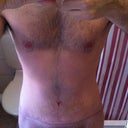 Post Op - Day 23 - After my second PO visit and with silicone tape.