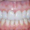 Veneers