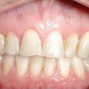 Veneers