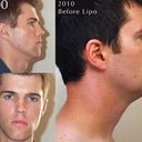 I starved myself at age 20 (as you can see in the front view) to get rid of the double chin, but the fat under my chin remained