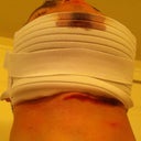 Morning after lipo - the compression garment slipped down and caused a bruise along my neck.