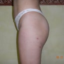 Left side 4 weeks after fat transfers