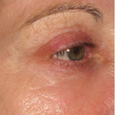 63 Year Old Female Treated For Wrinkles Around The Eye With Total Fx