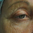 63 Year Old Female Treated For Wrinkles Around The Eye With Total Fx
