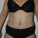 5 Weeks Post-op-Swelling!