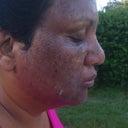 1 day after side view