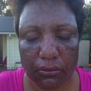 1 day after front view