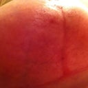 Week 8 Right T zone.  You can see that tiny scab which I believe is a stitch.