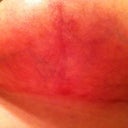Week 8 Left Tzone.   Boy that Palmers is great.  Scars are already starting to look even better.