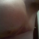 Day 5 - Bruising