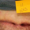 After 11 weeks. Almost 3 months! The small hole is almost closed. It is only open a small pinhole. It is more closed then it looks as it is sunken in but still drains a little. Other side probably has a few weeks yet.