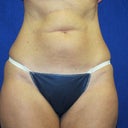 57 Year Old Female Had Liposonix Treatment To Abdomen And Flanks