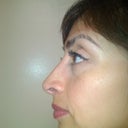 8 months after :)