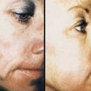 Chemical Peel 