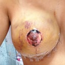 Right breast a little more than a week after second surgery