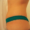 8/7
A little swollen above my scar