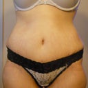 2weeks post op