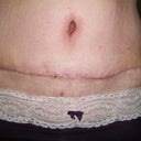 incision healing nicely according to Doc...