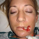 32 Year Old Female, Lip Reconstruction