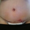 6 days post op