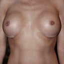 1st surgery. Implants placed too far laterally, not centered under nipple. No capsular contracture, symmetrical.
