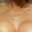 Post op swelling and "perkiness" that I wish were permanant!  Taken 5 days post op