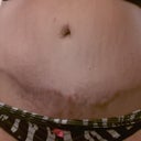 scar... almost a year and it still looks awful...