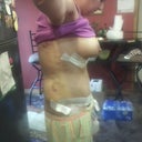 5 Days post op- side view-lots of swelling....I have to remind my self to be patient because I can't see the change yet