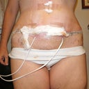 Day 5 with drains, bandages, bruising and swelling - lots of pharmasutical help ~ no pain.