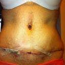 Day 10 with tape on my scar - no drains!!!! Such a relief to have those out of the way. Doc did muscle repair 8" long by 1 1/2" wide...yea!