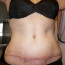 Day 19 Front "After" - Scar looks a little crooked but I don't care.