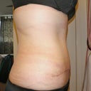 Day 19 Side view - I'm so thrilled!