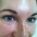 NOW. Loose skin when I smile or talk. It folds under my eye.