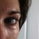 DURING hyaluronidase treatment. Still a small bulge under left eye after 5 rounds of injections to dissolve the filler. It dissolved unevenly.