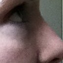 DURING dissolving process. Sorry bad quality photo but you can see the swollen lower lid. This is after months of hyaluronidase treatments.