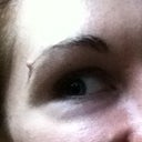 DURING. After several months of Hyaluronidase. Still overly full lower lid with Tyndall effect (blue/purple color through skin). No wrinkles or folds when smiling yet because the skin is still heavily inflated with filler.