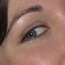 BEFORE Juvederm overfill and hyaluronidase. Pic from 2009. Residual restylane still in lower lid. Full smile but no lines, wrinkles or folds. No purple tear trough. Skin is a good healthy color.