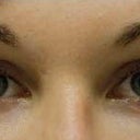 BEFORE Juvederm in January 2010. Note no natural bags or excess skin. NO PURPLE TEAR TROUGH.