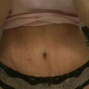 17 days post op..