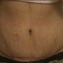My scar 17 days post op