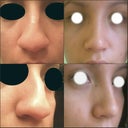 Left: Before surgery, Right: 2 months and four days after surgery. I am completely happy with the results!