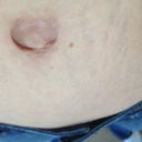 Belly button from my view. Really, all this is better than some loose skin and stretch marks?