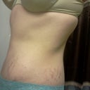 Left  side. 5 weeks post op