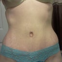 Front.  5 weeks post op