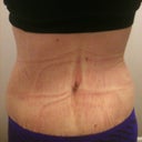 3 Weeks post op in the morning.  I get rounder as the day progresses.