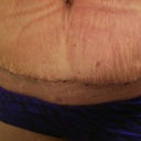 3 Week Incision, I hope it looks normal?