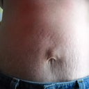 mini tummy tuck