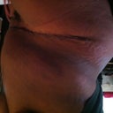 Day 3 Post op Very swollen