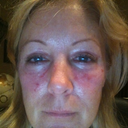 one week post op - laser resurfacing, never again. SKIN is killing me, surgery spots are fine though!!