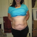 23 June Pre op picture 1